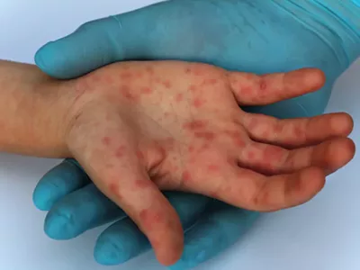 Image: Mystery solved: How measles came to Oakland County and infected 39 people