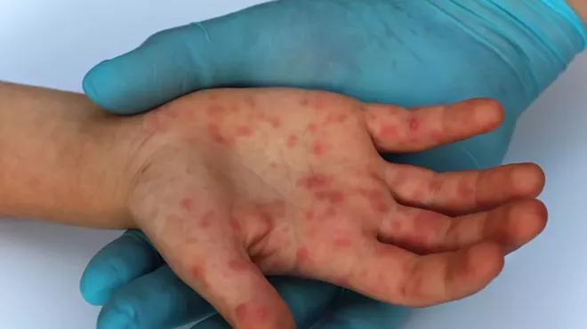 Image: Mystery solved: How measles came to Oakland County and infected 39 people