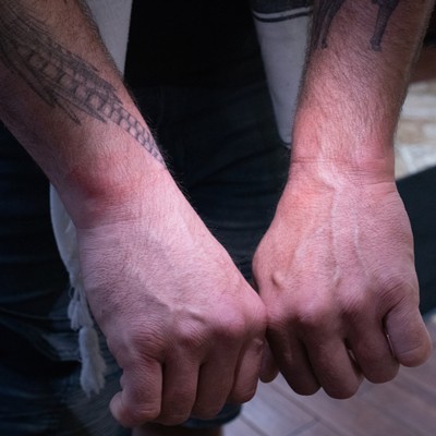 Taj's wrists later Sunday night, still red from being tightly cuffed.