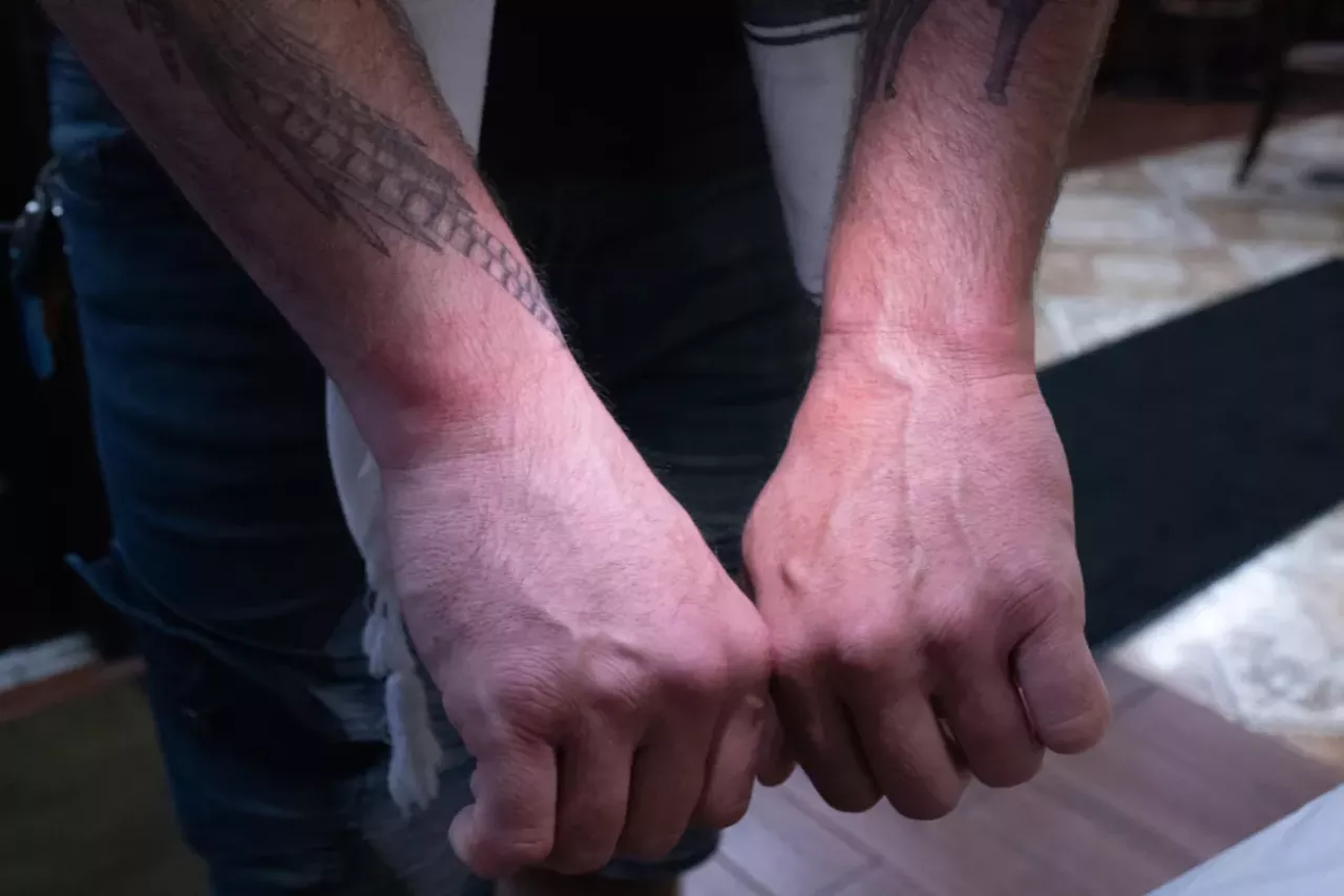 Taj's wrists later Sunday night, still red from being tightly cuffed.