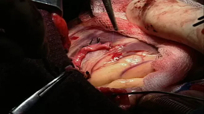 Forks Over Knives: Delicious heart bypass surgery.