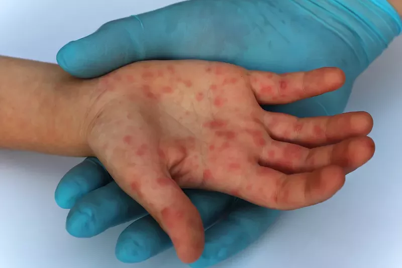 Mystery solved: How measles came to Oakland County and infected 39 people