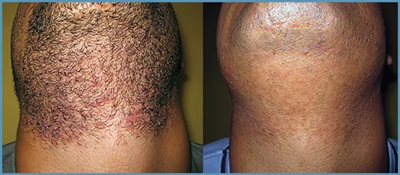 Ditch the Wax & Toss the Razor—Why Laser Hair Removal is for Everyone!